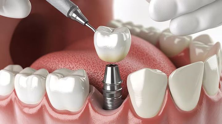 Dental Implants Explained: Advanced Restoration Techniques, Clinical Procedures and Oral Health Applications